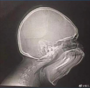 拍牙片時(shí)打了個(gè)哈欠，變成了毒液？用3D打印技術(shù)制作牙齒的好處